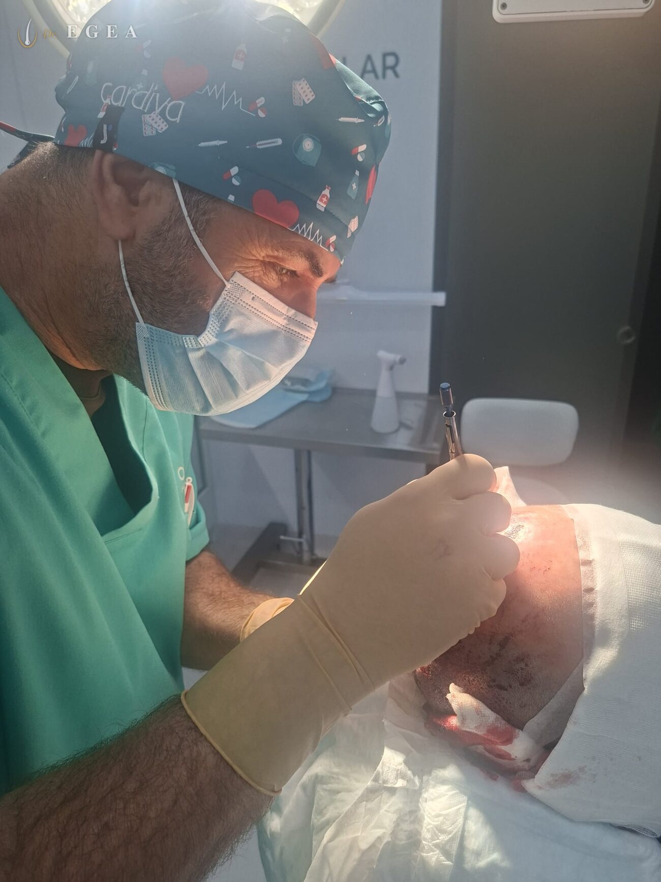 Extracción folicular FUE en cirugía capilar